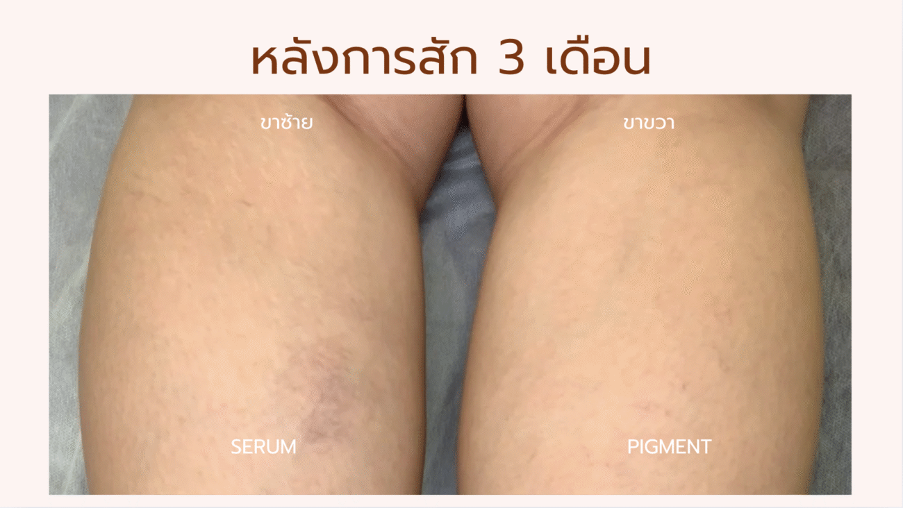 Before & After Pigment Serum